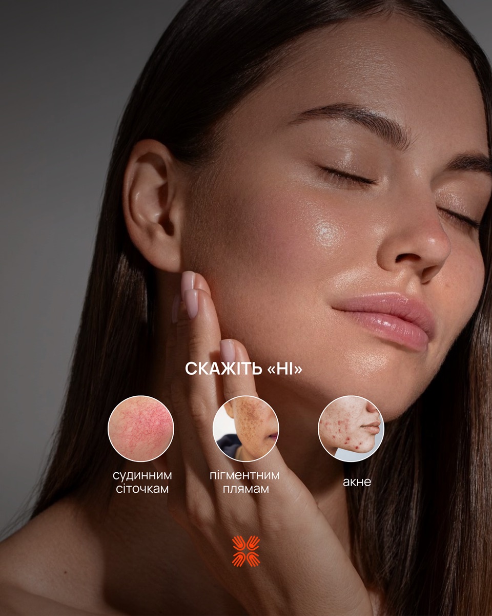 Жовтий лазер для обличчя: безболісне рішення від куперозу, судинної сіточки і почервоніння