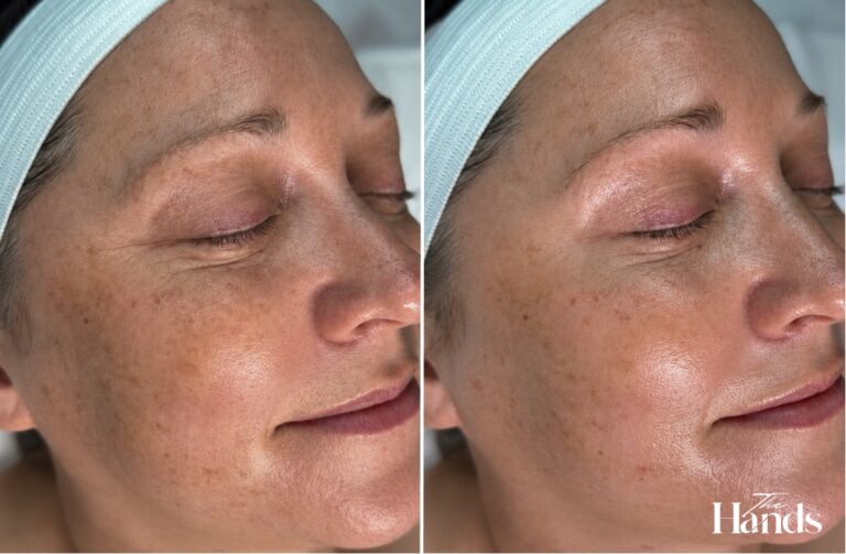 МІКРОТОКИ ZERO PEEL